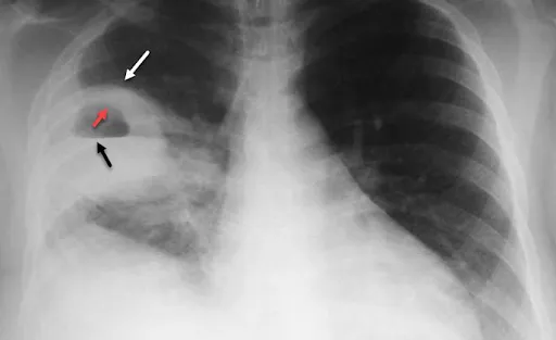 Áp xe phổi là biến chứng có thể gặp do viêm phổi gây ra